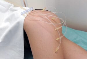 озонотерапия для тела